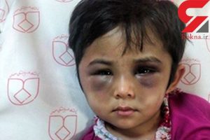 عکس وحشتناک از چهره کبود شده دختر اصفهانی / این ماجرا اشک همه را در می آورد