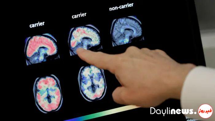 داروی آلزایمر پس از ۲۰ سال به تایید سازمان غذا و دارو آمریکا رسید
