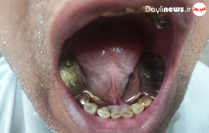 بازداشت مردی که یک کیلو طلا در دهان داشت!
