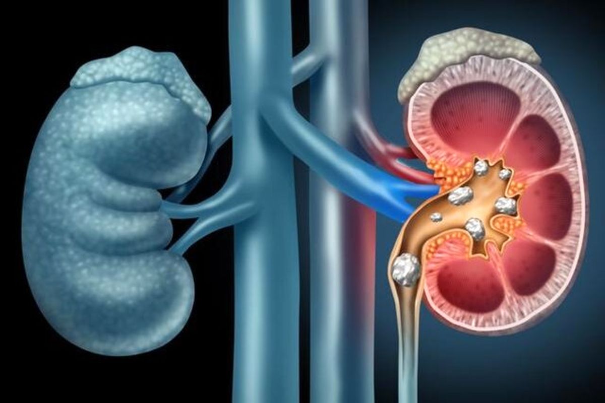 چگونه می‌توان از ابتلا به سنگ کلیه پیشگیری کرد؟