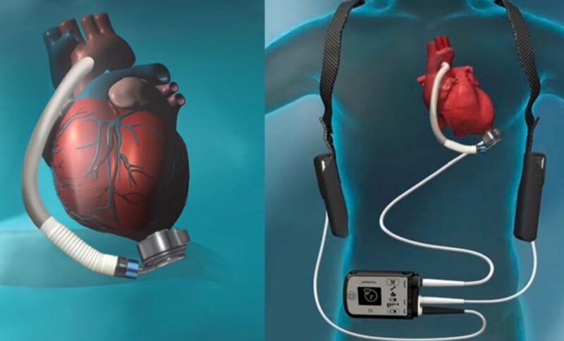 این زن آمریکایی نبض ندارد و با باتری زندگی میکند