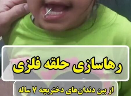 رهاسازی حلقه فلزی از میان دندان‌های دختر بچه ۷ ساله دزفولی