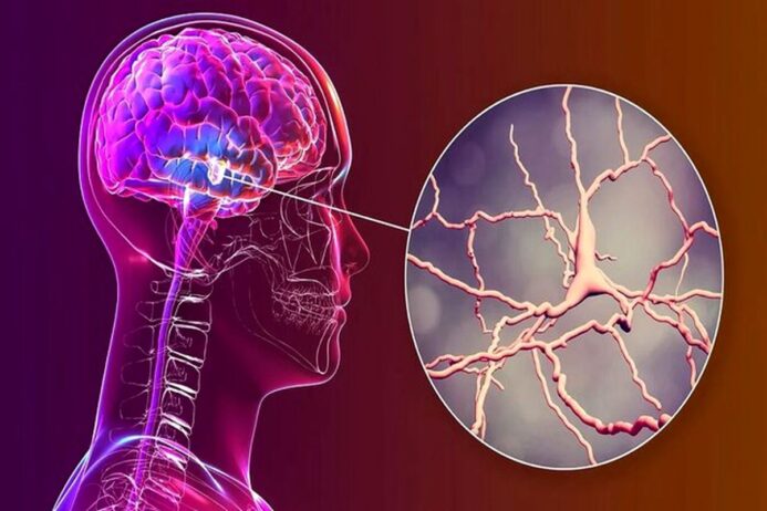 رابطه مستقل لرزش در بیماری پارکینسون با عملکرد دوپامین در مغز
