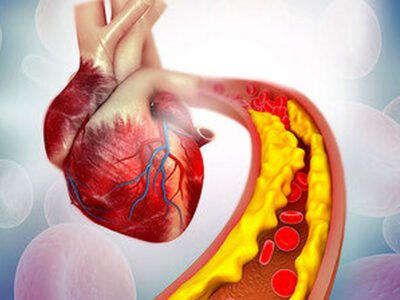 بهترین پیشنهاد برای کاهش کلسترول خون