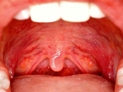 علائم سرطان گلو چیست؟