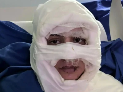 زنی در استانبول به اتهام سوزاندن چهره یک زن جوان روانه زندان شد